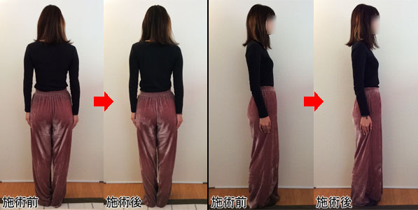 T.Mさんの施術前後写真